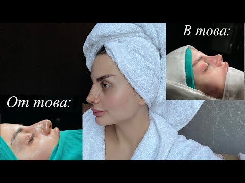 Видео: Ринопластика: Целият процес през моите очи – Всичко, което трябва да знаете!