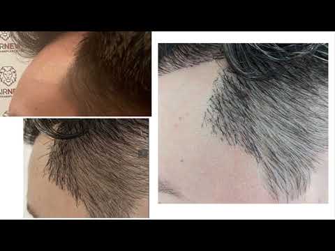 Видео: Опасно! Пересадка волос в Турции у Красавчик и HairNeva и Alim Süleyman.