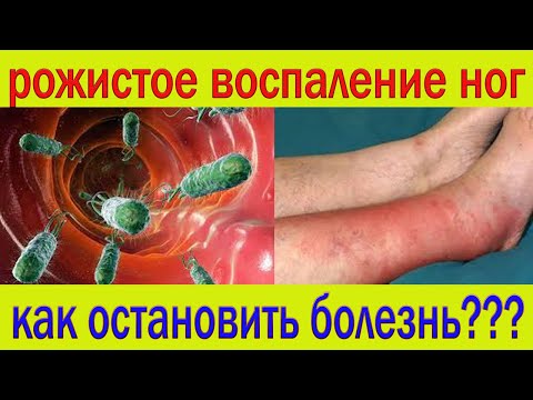 Видео: Рожистое воспаление ног. Как остановить болезнь...