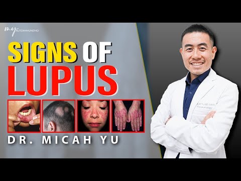 Видео: 10 ПРИЗНАКОВ волчанки, КОТОРЫЕ НЕ СЛЕДУЕТ ПРОПУСТИТЬ. Консультация ревматолога | Доктор Мика Ю