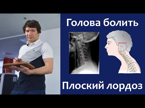 Видео: Плоский лордоз та головний біль, як це пов'язано?