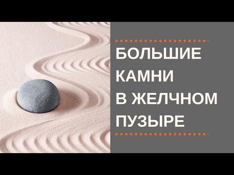 Видео: Большие Камни в Желчном.  Больше 2 см.  Что делать?