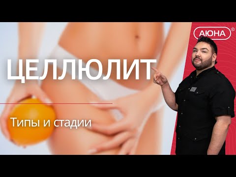Видео: ЦЕЛЛЮЛИТ: типы и стадии
