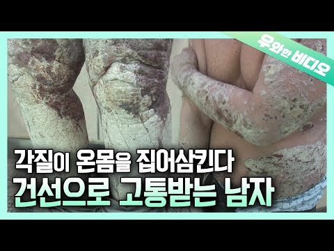 Видео: Бездомный человек болеет псориазом