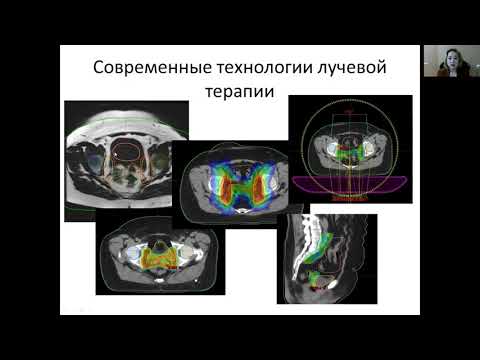 Видео: Адъювантная лучевая терапия рака эндометрия