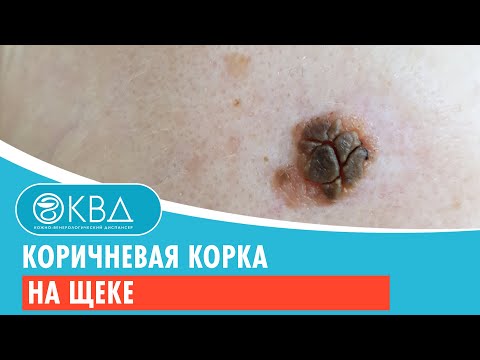 Видео: 😕 Коричневая корка на щеке. Клинический случай №923