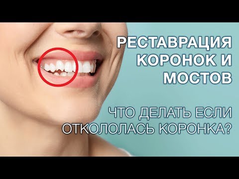 Видео: Реставрация керамической коронки при сколе.