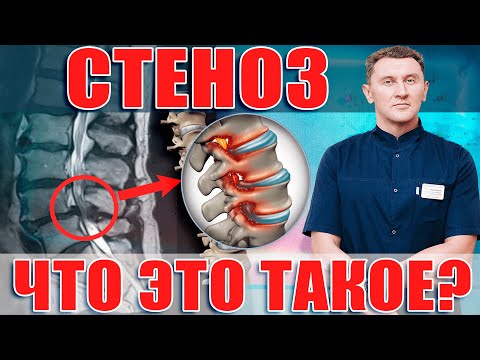 Видео: Стеноз позвоночного канала| Причины появления и виды стеноза!