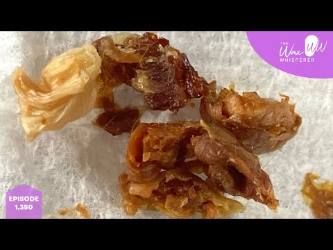 Видео: 1350 – успешное лечение пациентов с болезненным обтурирующим кератозом II степени