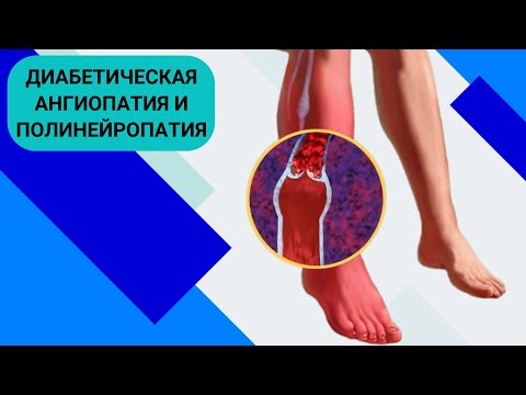 Видео: ДИАБЕТИЧЕСКАЯ АНГИОПАТИЯ И ПОЛИНЕЙРОПАТИЯ