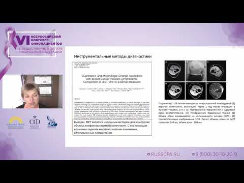 Видео: Обухова Ольга Аркадьевна - Онкореабилитационное отделение и его возможности для пациентов