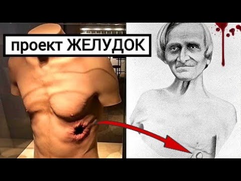 Видео: ЧЕЛОВЕК ЧЕЙ ЖЕЛУДОК ВИДЕЛ СВЕТ