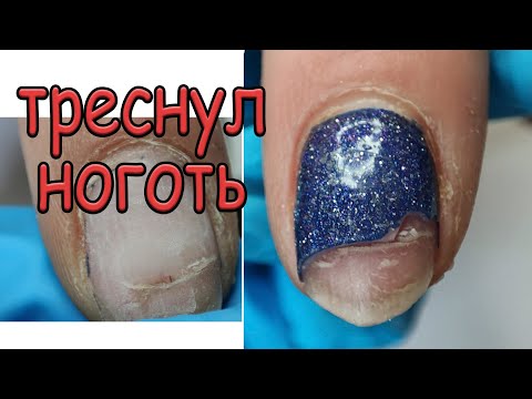 Видео: ТРЕСНУЛ НОГОТЬ // СВЕТООТРАЖАЙКА СО СВЕТООТРАЖАЙКОЙ НА СВЕТООТРАЖАЙКЕ