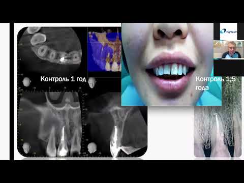 Видео: Вебинар Александра Миловидова: Комбинации инструментов в эндодонтическом лечении