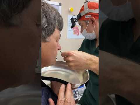 Видео: Промывание гайморовой пазухи через искусственное соустье