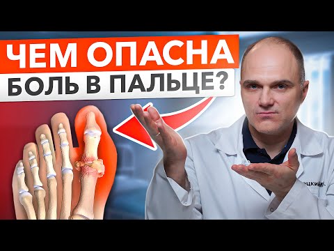 Видео: Эти причины артроза большого пальца стопы легко узнает каждый. Что такое Халюс Ригидус?