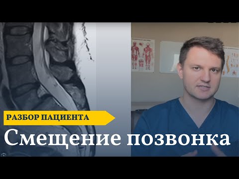 Видео: Боль в спине, когда стою | Смещение позвонка и нестабильность | Тесты и упражнения при боли