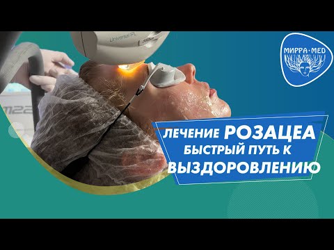 Видео: Розацеа, сосуды, сеточки на лице. Самая эффективная методика лечения розацеа