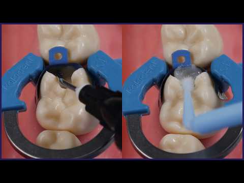 Видео: Как: высота краевого гребня при реставрации зубов II класса | Советы доктора Линкольна Харриса