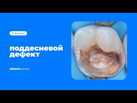 Видео: Поддесневые дефекты. Выпуск 5. aikdent.school