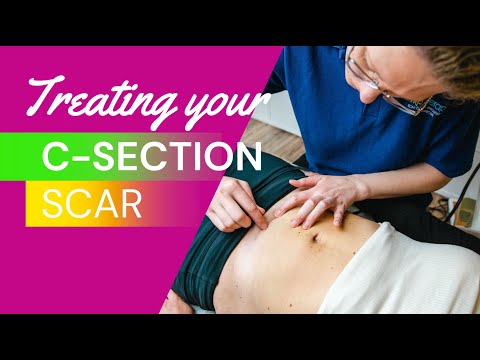 Видео: Лечение рубца после кесарева сечения с помощью массажных техник — HLP-терапия