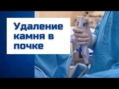 Видео: Удаление камней в почках | Лазерная уретеролитотрипсия