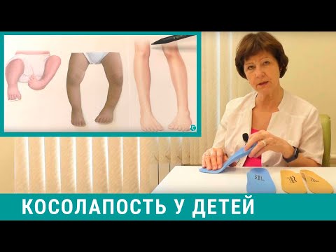 Видео: Косолапость у детей - лечение косолапости, как исправить?