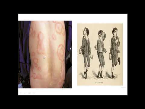 Видео: Хэрэх өвчинүү? Ревматойд артрит уу? by Tsengel