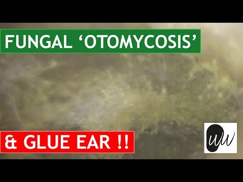 Видео: САМОЕ СЛОЖНОЕ УШНОЕ ИНФЕКЦИОННОЕ СРЕДСТВО, СВЯЗАННОЕ С ОТОМИКОЗОМ, ИЗБАВЛЕНИЕ ОТ УША С ПОМОЩЬЮ КЛ...