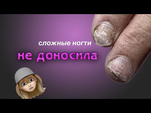 Видео: коррекция сложных ногтей 🤯 оторвало кусок ложа