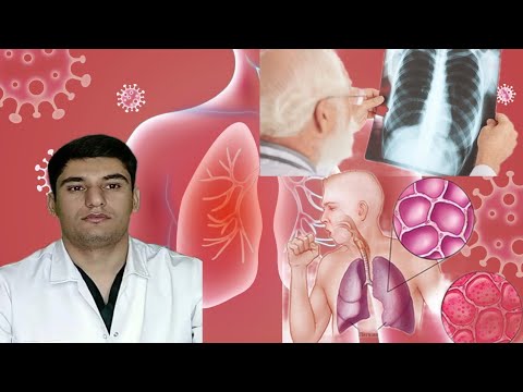 Видео: Пневмония: намудҳояш, сабабҳояш, нишонаҳояш, ташхисҳояш, табобатҳояш ва пешгириаш.پنومونی. zotiljam.