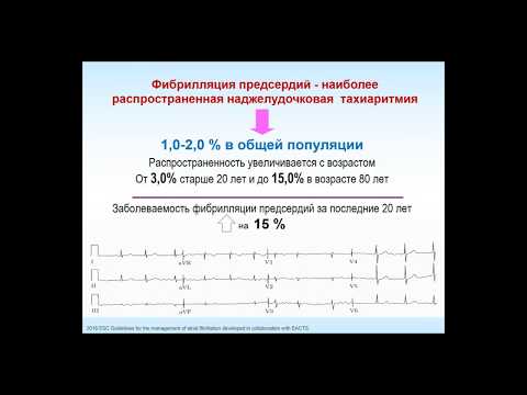 Видео: Разбор клинического случая «Пациент молодого возраста с фибрилляцией предсердий»