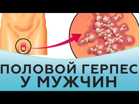 Видео: Как выглядит половой герпес у мужчин