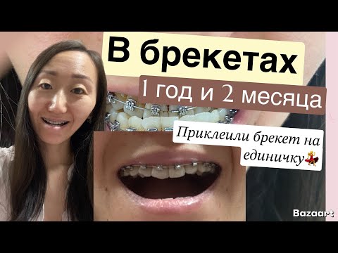 Видео: ПРИКЛЕИЛИ БРЕКЕТ НА ЕДИНИЧКУ💃 1 ГОД И ДВА МЕСЯЦА В БРЕКЕТАХ✍️