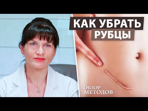 Видео: Как избавиться от шрамов? Келоидный рубец. Обзор методов от врача косметолога