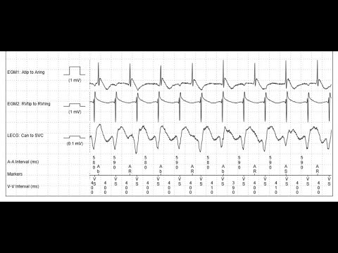 Видео: Работа имплантируемого кардиовертера - дефибриллятора. Мастер-класс с виртуальным пациентом