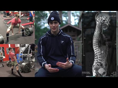 Видео: Погубил СПИНУ/ РЕЗУЛЬТАТЫ МРТ | David Laid Q&A