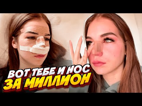 Видео: ВСЯ ПРАВДА О МОЕЙ РИНОПЛАСТИКЕ... ДО / ПОСЛЕ