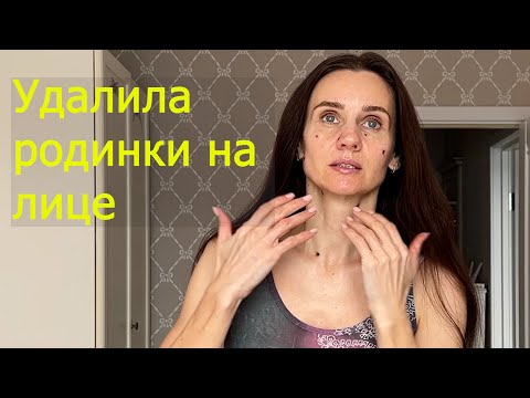 Видео: Удалила РОДИНКИ на лице. Что самое сложное. Реальный отзыв. Неприятный момент.