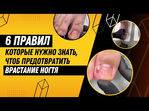 Видео: 6 ПРАВИЛ, которые нужно знать, чтоб предотвратить врастание ногтя / ноготь / #ногти #помощь