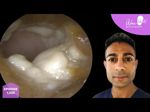 Видео: 1335 – Снятие противогрибкового крема для снятия слепков ушей при хронической инфекции Aspergillu...