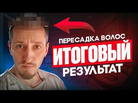 Видео: Прошел год после пересадки волос, вся правда