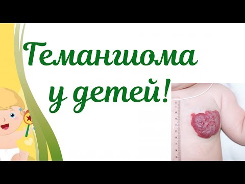 Видео: Гемангиома у новорожденных.👼Действия мамы при гемангиоме!