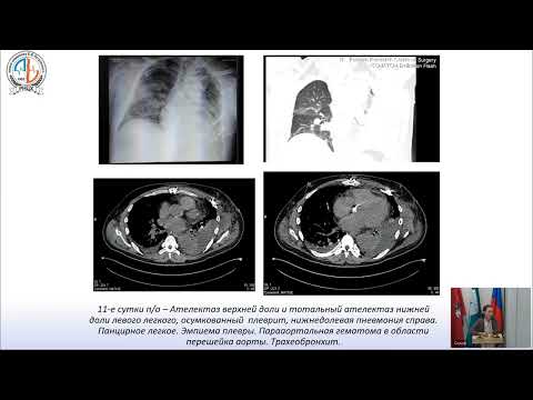 Видео: 19.11.24 Круглый стол «Реабилитация в реаниматологии»
