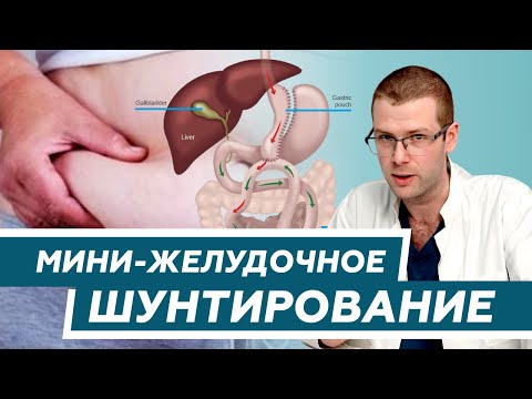 Видео: Мини-желудочное шунтирование