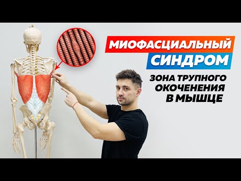 Видео: Миофасциальный синдром. Что такое МФС?