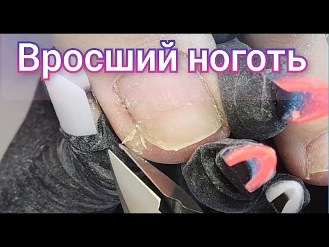 Видео: ВРОСШИЙ НОГОТЬ. ТАМПОНАДА ВРОСШЕГО НОГТЯ. ПОЧЕМУ НЕЛЬЗЯ ПЕРЕНАШИВАТЬ ПОКРЫТИЕ. ГИДРОЗНАЯ СТОПА