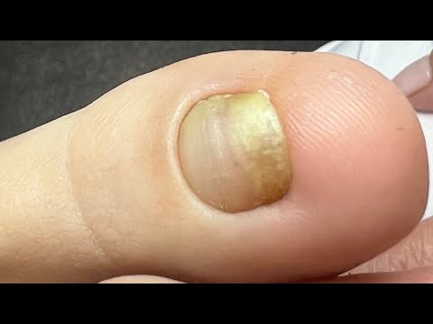 Видео: Онихолизис | переделка после другого мастера | Установка системы ЗТО