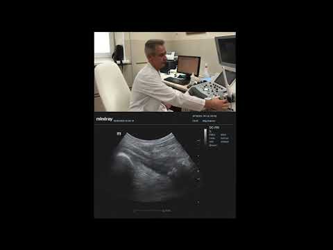 Видео: Технология УЗИ вен нижних конечностей