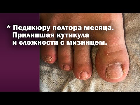Видео: Педикюр спустя полтора месяца ❤️ Подробно о обработке пальчиков ‼️